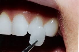 clareamento-dentario