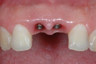 Clínica de implante dentário