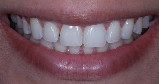 Dentes permanentes