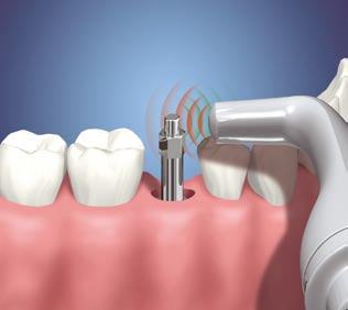 implante-de-dente-preco