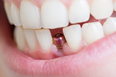 implante-dentario-preco