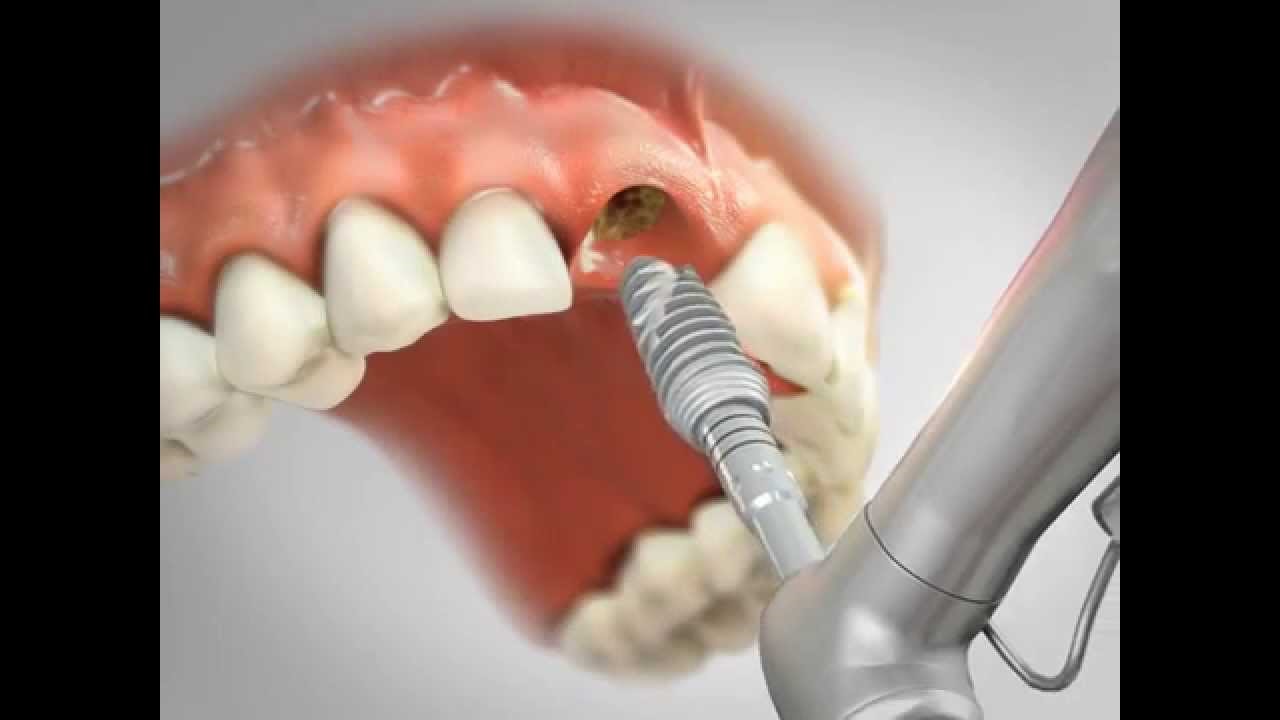 Preço de implante de dente