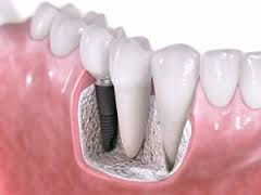 preco-de-implante-dentario