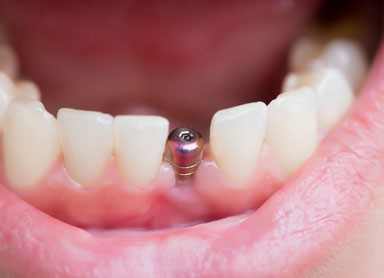 Preço de implante dentário